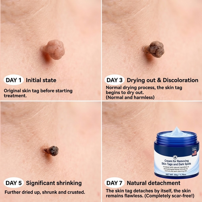 Advanced Correcting Cream for Skin Tags, Moles & Spots – 7‑Day Painless & Scar‑Free – Advanced Care for Skin Imperfections