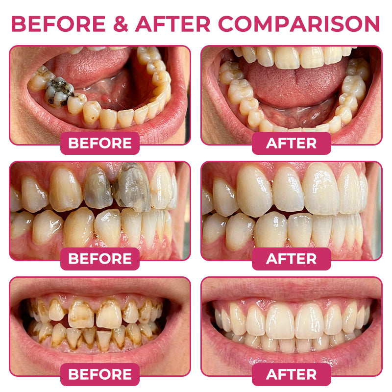 COUGEX®  Cavity-Repair Natural Enamel Filling Gel