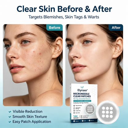 Elyraxo™ MicroNeedle Clear Skin Patches – 144 Hydrocolloid Patches for Blemishes, Skin Imperfections & Targeted Skin Care